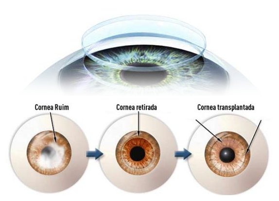 Tive Ceratocone e fiz transplante de córnea